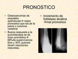 PRONOSTICO Osteosarcomas de esqueleto apendicular   mejor pronostico que los de la pelvis o columna vertebral Buena respuesta a la quimioterapia es de buen pronostico   68%de supervivencia libre y 30% quienes tienen reacciones reducidas. Incremento de fosfatasa alcalina   mal pronostico 
