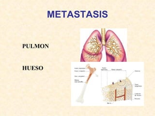 METASTASIS PULMON HUESO 