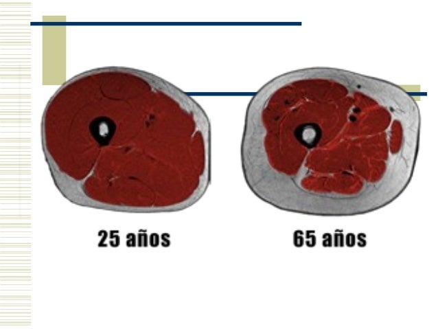 Sarcopenia en el anciano Sarcopenia en el anciano