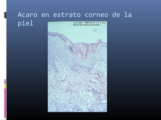 Acaro en estrato corneo de la
piel
 