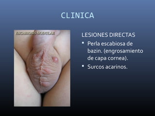CLINICA
LESIONES DIRECTAS
 Perla escabiosa de
bazin. (engrosamiento
de capa cornea).
 Surcos acarinos.
 