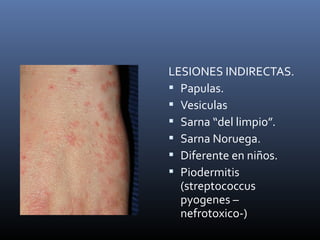 LESIONES INDIRECTAS.
 Papulas.
 Vesiculas
 Sarna “del limpio”.
 Sarna Noruega.
 Diferente en niños.
 Piodermitis
(streptococcus
pyogenes –
nefrotoxico-)
 