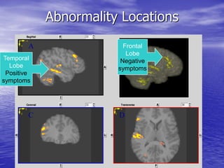 Schizophrenia: The Truth