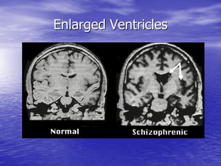 Schizophrenia: The Truth