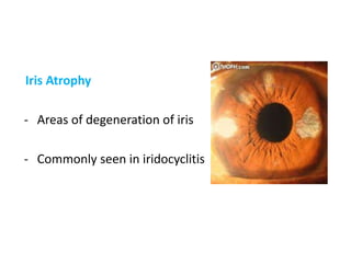 Uvea: Anatomy, Nerve & Vascular Supply, Clinical Correlation | PPTX