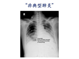 “非典型肺炎”
 