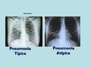 PPnneeuummoonniiaa 
TTííppiiccaa 
PPnneeuummoonniiaa 
AAttííppiiccaa 
PPnneeuummoonniiaa 
 