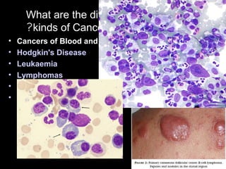 What are the different
kinds of Cancer?
• Cancers of Blood and Lymphatic Systems:
• Hodgkin's Disease
• Leukaemia
• Lymphomas
• Multiple Myeloma
• Waldenström's Disease
 
