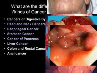 What are the different
kinds of Cancer?
• Cancers of Digestive Systems:
• Head and Neck Cancers
• Esophageal Cancer
• Stomach Cancer
• Cancer of Pancreas
• Liver Cancer
• Colon and Rectal Cancer
• Anal cancer
 
