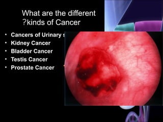 What are the different
kinds of Cancer?
• Cancers of Urinary system:
• Kidney Cancer
• Bladder Cancer
• Testis Cancer
• Prostate Cancer
 