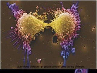 Cancer Is One Outcome of A Runaway Cell Cycle
Licentious division - prostate cancer cells during division.
 