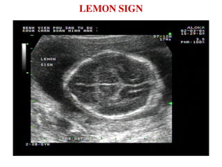 LEMON SIGN
 