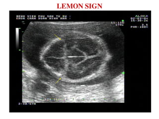 LEMON SIGN
 