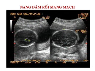 NANG ÑAÙM ROÁI MAÏNG MAÏCH
 