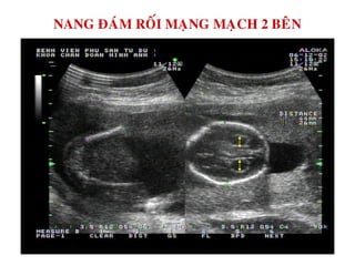 NANG ÑAÙM ROÁI MAÏNG MAÏCH 2 BEÂN
 