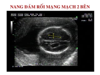 NANG ÑAÙM ROÁI MAÏNG MAÏCH 2 BEÂN
 