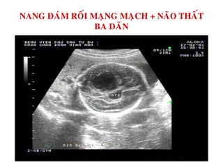 NANG ÑAÙM ROÁI MAÏNG MAÏCH + NAÕO THAÁT
BA DAÕN
 