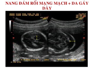 NANG ÑAÙM ROÁI MAÏNG MAÏCH + DA GAÙY
DAØY
 