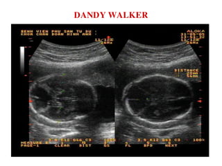 DANDY WALKER
 