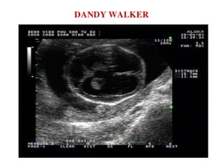 DANDY WALKER
 