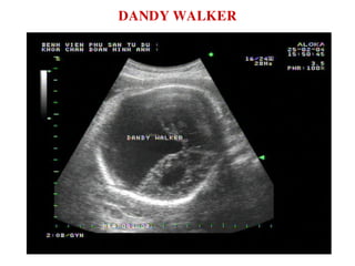 DANDY WALKER
 