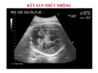 BAÁT SAÛN THUØY NHOÄNG
 