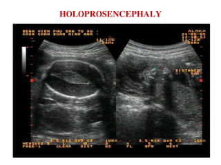HOLOPROSENCEPHALY
 
