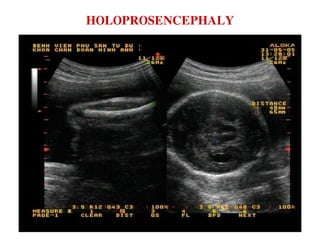 HOLOPROSENCEPHALY
 