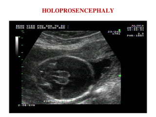 HOLOPROSENCEPHALY
 