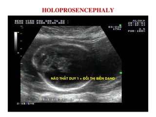 HOLOPROSENCEPHALY
NAÕO THAÁT DUY 1 + ÑOÀI THÒ BIEÁN DAÏNG
 
