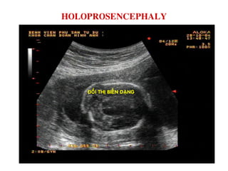 HOLOPROSENCEPHALY
ÑOÀI THÒ BIEÁN DAÏNG
 