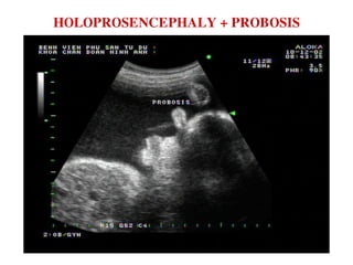 HOLOPROSENCEPHALY + PROBOSIS
 