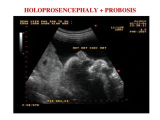 HOLOPROSENCEPHALY + PROBOSIS
 