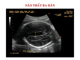 NAÕO THAÁT BA DAÕN
 