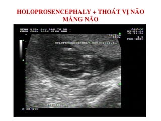 HOLOPROSENCEPHALY + THOAÙT VÒ NAÕO
MAØNG NAÕO
 