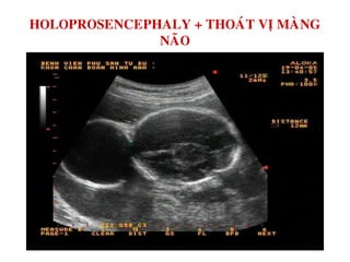 HOLOPROSENCEPHALY + THOAÙT VÒ MAØNG
NAÕO
 