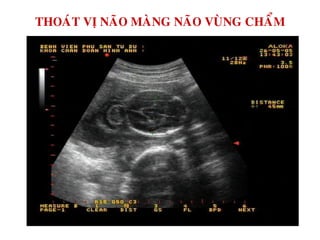 THOAÙT VÒ NAÕO MAØNG NAÕO VUØNG CHAÅM
 