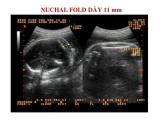 NUCHAL FOLD DAØY 11 mm
 