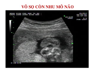 VOÂ SOÏ COØN NHU MOÂ NAÕO
 