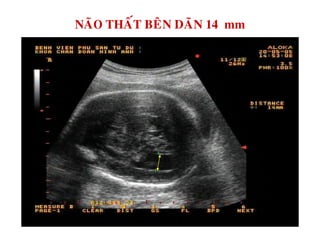 NAÕO THAÁT BEÂN DAÕN 14 mm
 