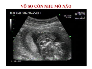 VOÂ SOÏ COØN NHU MOÂ NAÕO
 