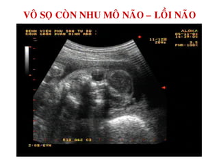VOÂ SOÏ COØN NHU MOÂ NAÕO – LOÀI NAÕO
 