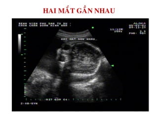 HAI MAÉT GAÀN NHAU
 