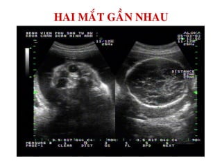 HAI MAÉT GAÀN NHAU
 