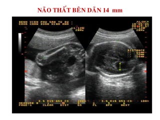 NAÕO THAÁT BEÂN DAÕN 14 mm
 