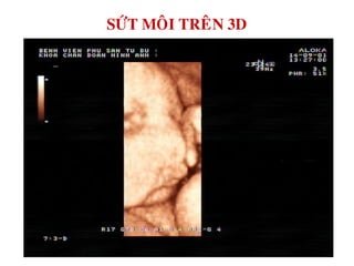 SÖÙT MOÂI TREÂN 3D
 