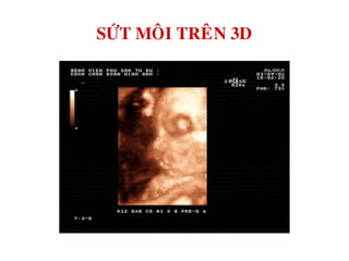 SÖÙT MOÂI TREÂN 3D
 