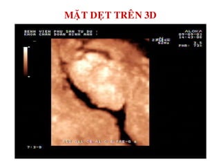 MAËT DEÏT TREÂN 3D
 