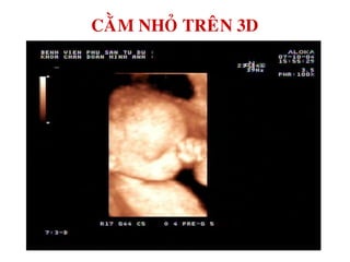 CAÈM NHOÛ TREÂN 3D
 