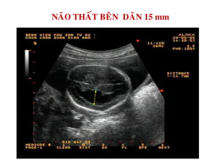 NAÕO THAÁT BEÂN DAÕN 15 mm
 